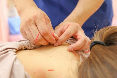 正社員 鍼灸師 接骨院・整骨院 鍼灸整骨院求人イメージ